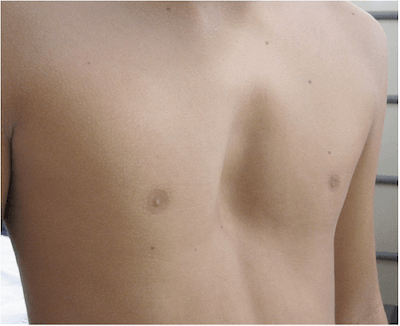 pectus excavatum