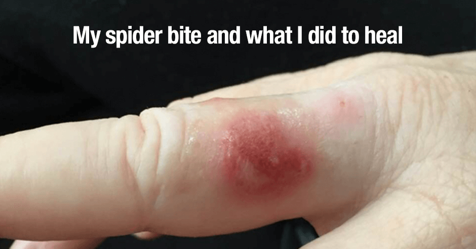 spider bite symptoms